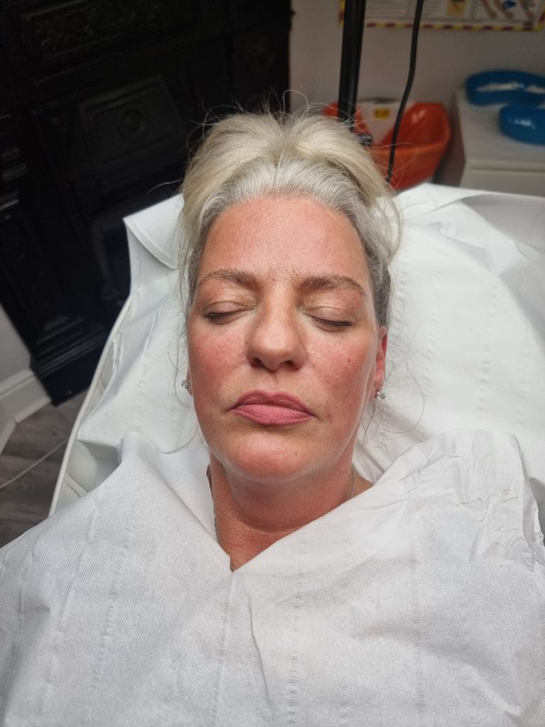 Client prepared for dermal filler treatment
