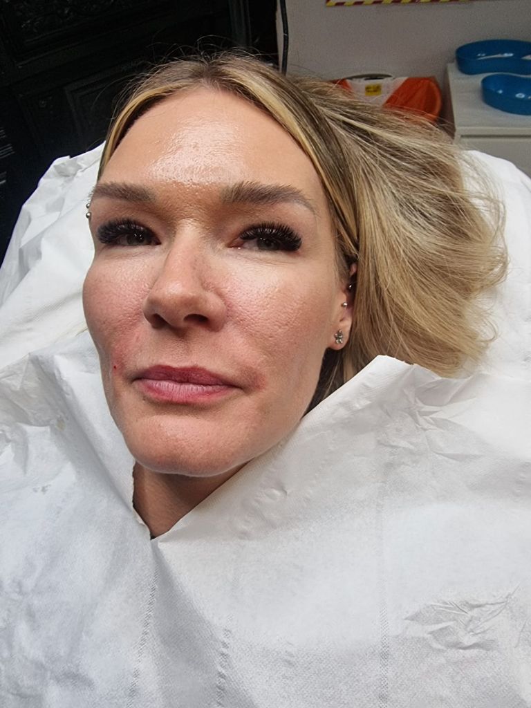Beautiful dermal filler enhancement result