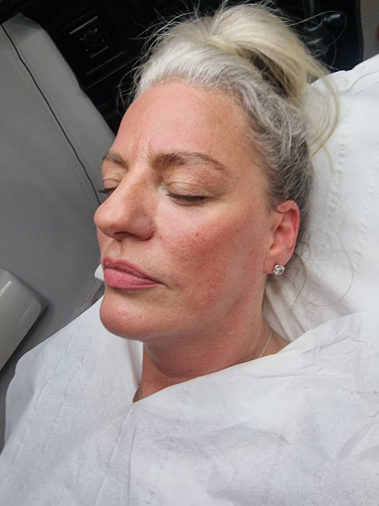 Pre-treatment nasolabial fold assessment