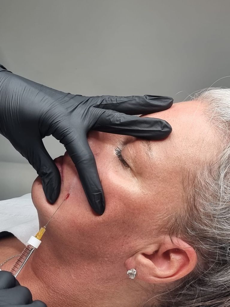 Dermal filler injection for nasolabial folds