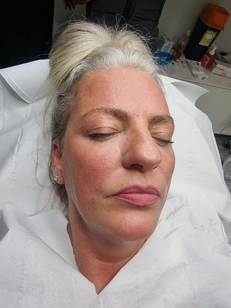 Post-treatment result for nasolabial folds