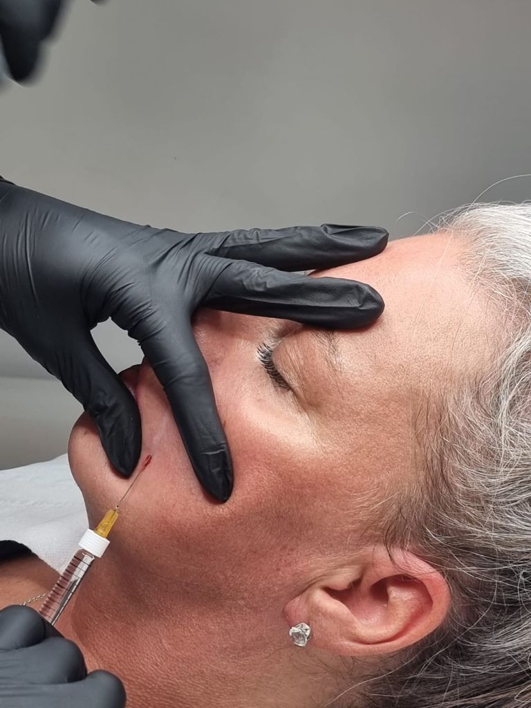Precision dermal filler injection technique