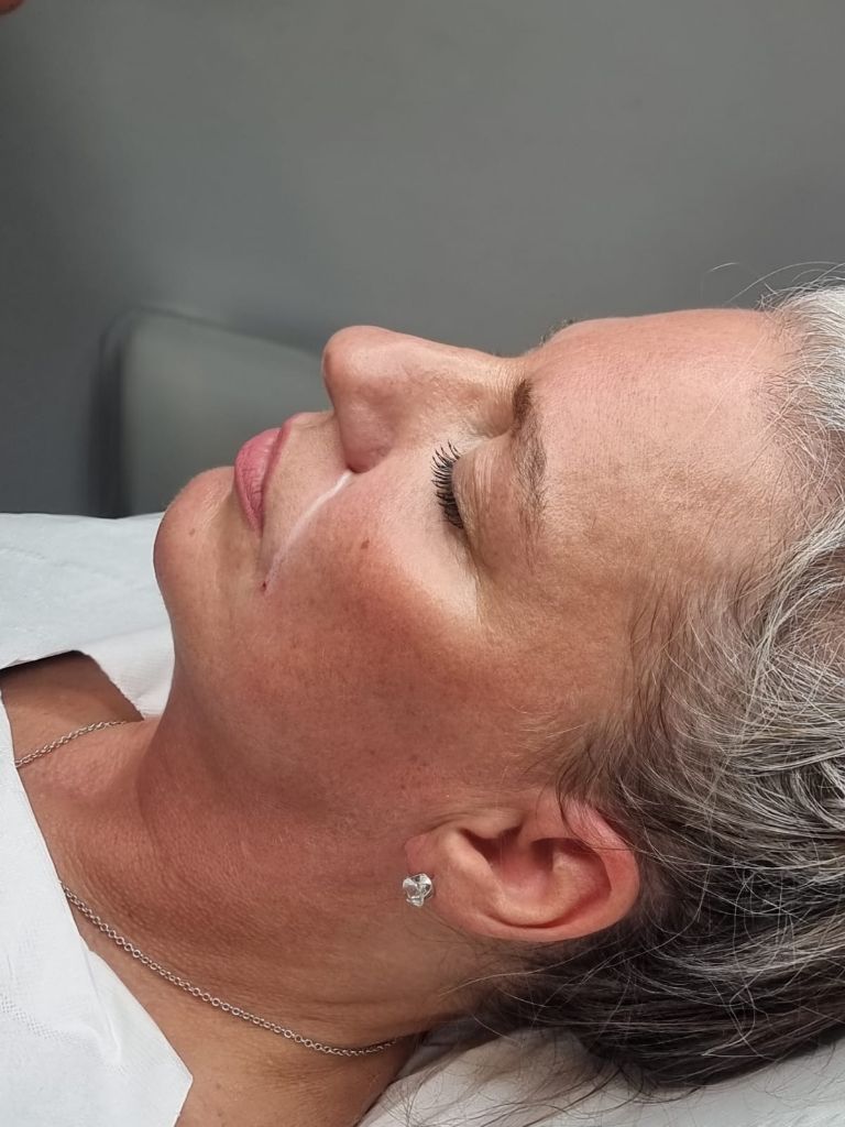Natural-looking dermal filler result