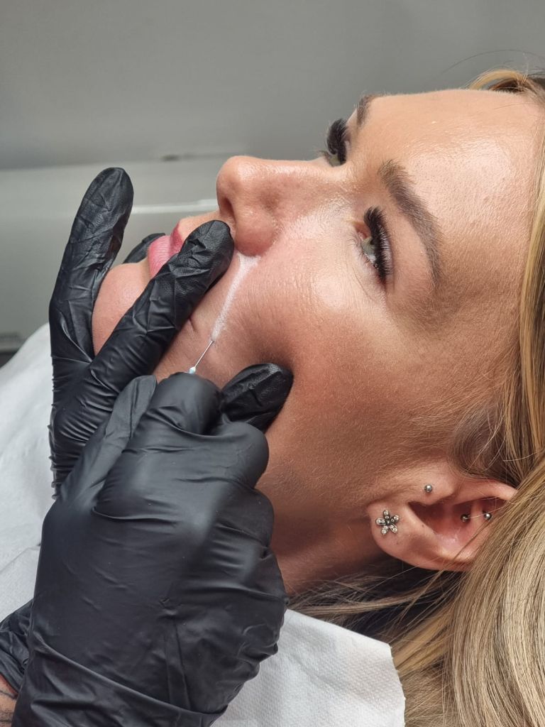 Detailed dermal filler injection process