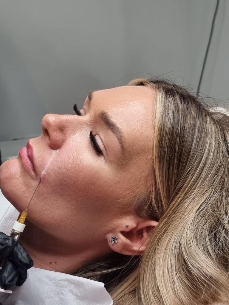Side profile dermal filler treatment