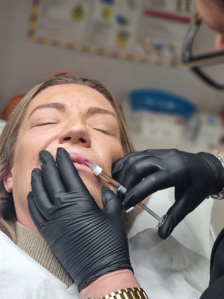 Lip filler treatment procedure
