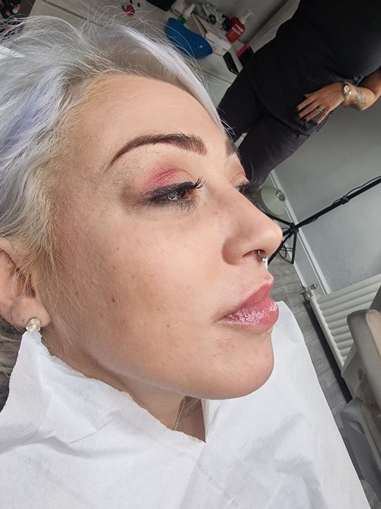 Post-treatment lip enhancement results