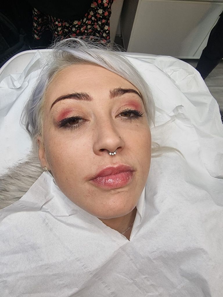 Natural lip augmentation result