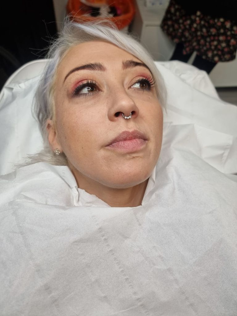 Lip filler consultation and treatment