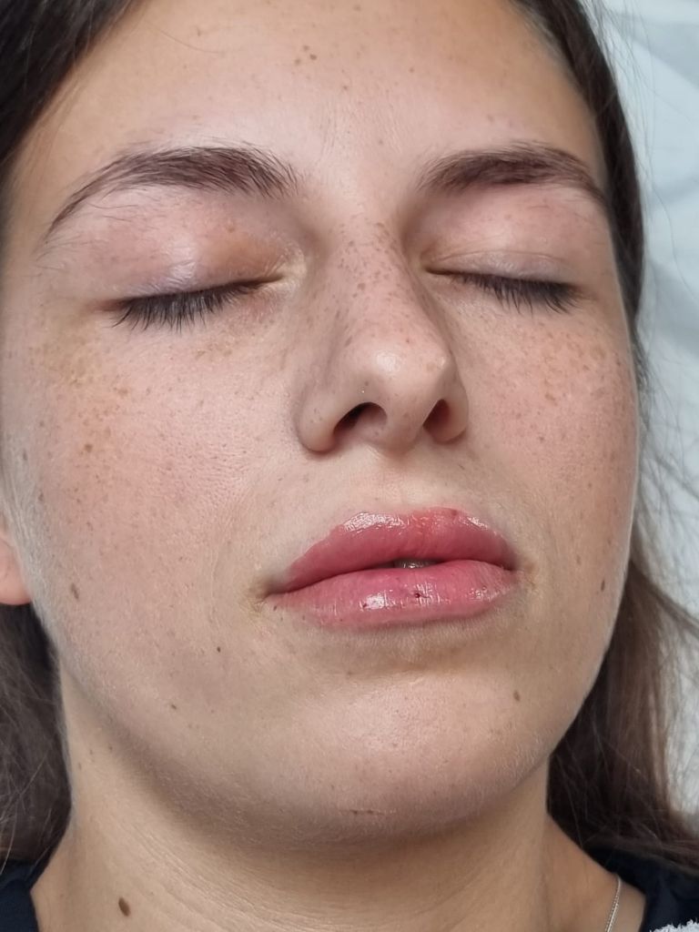Detailed lip enhancement procedure