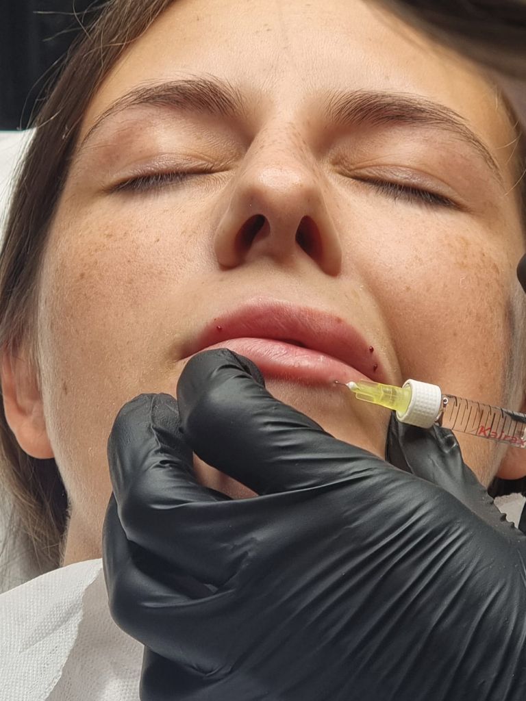 Professional lip injection technique
