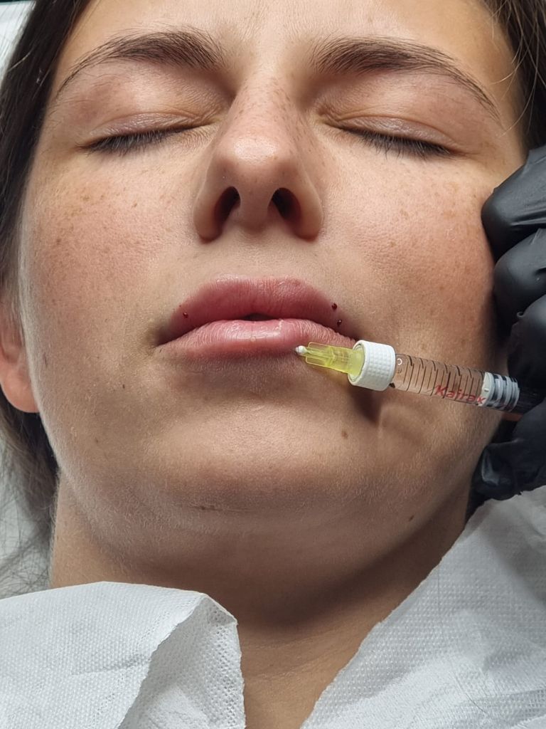Lip filler application close-up