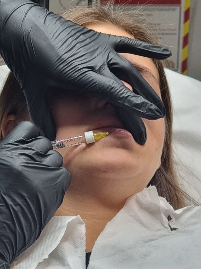 Precision lip augmentation technique